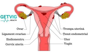 Endometrioza cauze simptome si tratament
