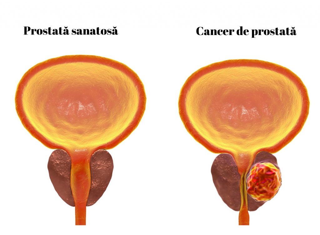 Sânge și proteine ​​în urină cu prostatită
