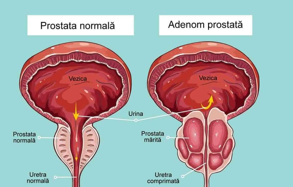 medicamente pentru adenom de prostată și urinare slabă