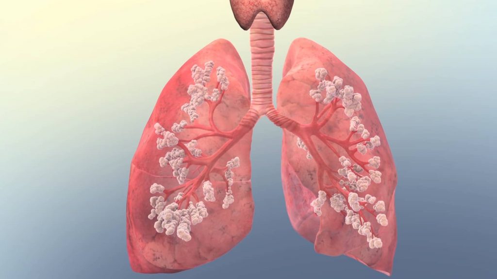 Afectiuni pulmonare