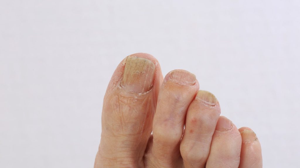 Pete albe pe unghii: cauze și tratament