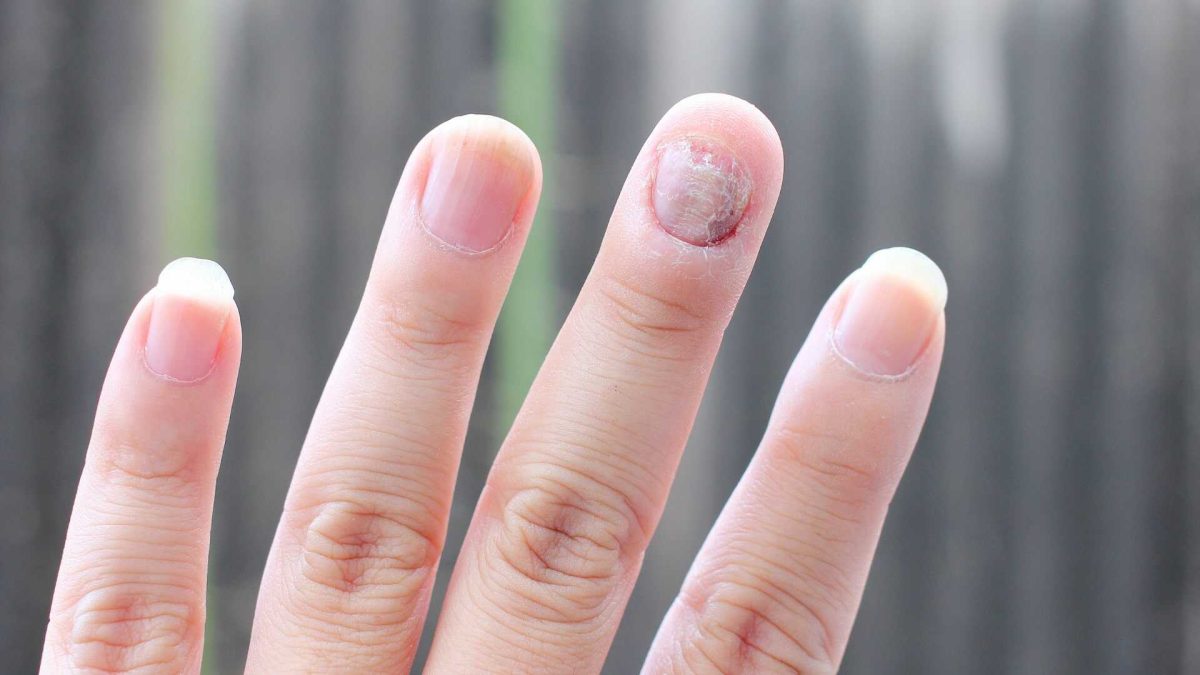 Грибковые заболевания на пальцах рук